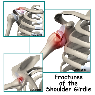 Adult Shoulder Fractures